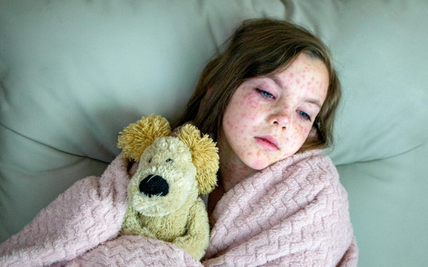 young girl in bed with measles