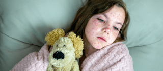 young girl in bed with measles