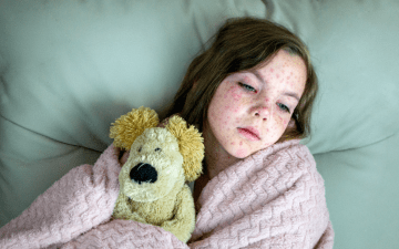young girl in bed with measles