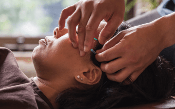 woman getting an acupuncture treatment on face