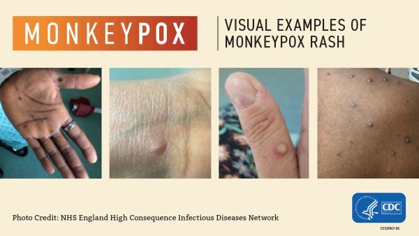 Monkeypox visual from the CDC